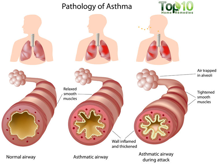 asthma dama ayurveda