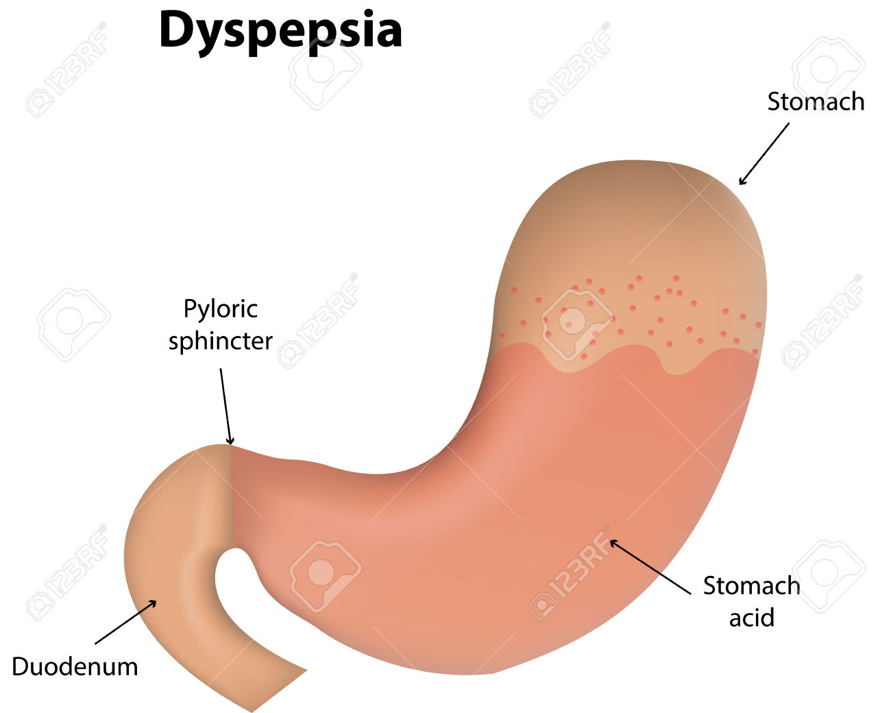 अजीर्ण ( Ajirna , Dyspepsia और Indigestion )