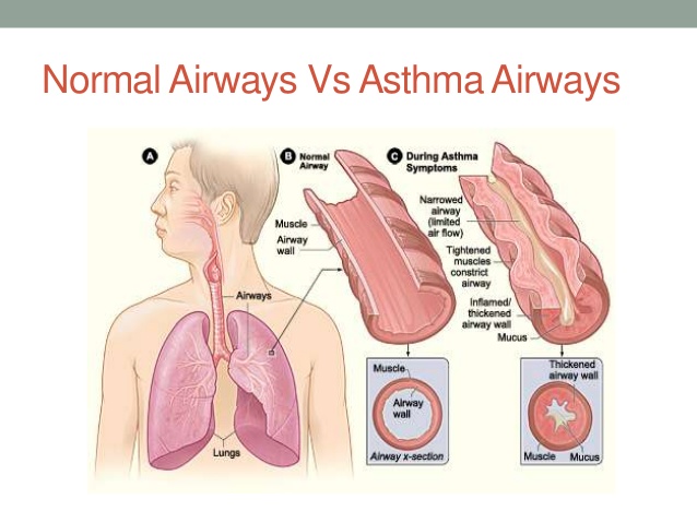 asthma dama ayurveda