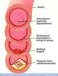 heart disease cholesterol ayurveda
