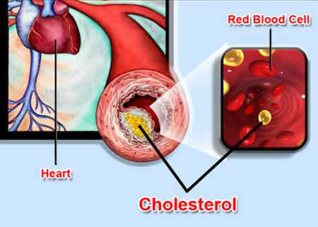 heart disease cholesterol ayurveda