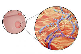 firang disease