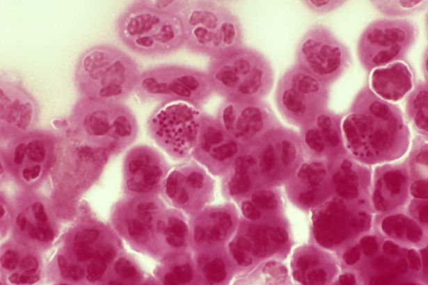 sujak, Gonorrhoea in hindi